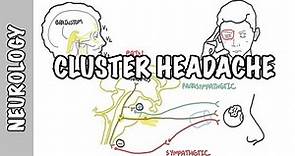 Cluster Headaches - symptoms, pathophysiology, treatment
