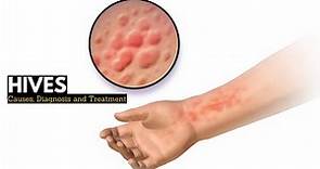 HIVES, Causes, Signs and Symptoms, Diagnosis and Treatment.