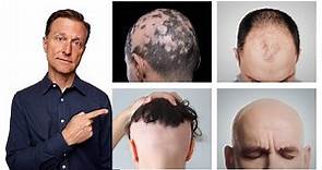 各類掉髮,頭髮稀疏,雄性禿,7種自然療法,柏格醫生 Dr Berg