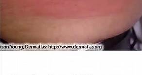 This is what the Lyme disease Rash Looks Like!