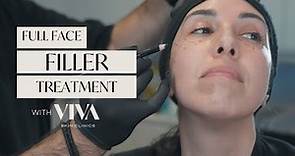 Full Face Filler Treatment - How to Lift and Contour with Dermal Fillers | 2023