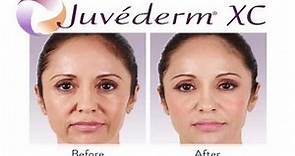 What Is The Difference between Juvederm, Voluma & Volbella?