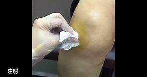 膝關節注射 玻尿酸 美麗新城診所 莊禮謙醫師 Intra-articular injection, OA knee,