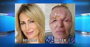 Protect Yourself from Facial Injection Disfigurement