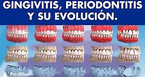 Gingivitis y periodontitis - Avance y evolución - Encías sangrantes ©