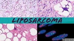 Liposarcoma 101: Everything a Pathologist Needs to Know