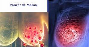 Cáncer de Mama: Anatomía básica, Concepto, Clasificación, Detección Temprana y Diagnóstico