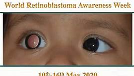 Retinoblastoma- Twinkle twinkle in the Eye