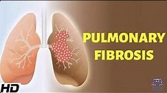 Pulmonary Fibrosis: Everything You Need To Know