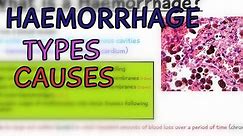 Pathology Lectures: Haemorrhage? Types and Causes (Hemorrhage) - EXPLAINED IN 4 MINUTES!