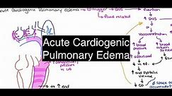 Acute Cardiogenic Pulmonary Edema