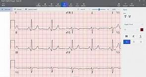 Insuficiencia Cardíaca Congestiva: Diagnóstico y Lectura ECG