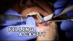 How Does A Dentist Fill A Cavity?