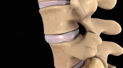 Back Pain: Lumbar Disc Injury