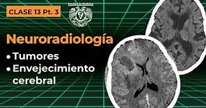 13.3 - Neuroradiología: Tumores y envejecimiento cerebral