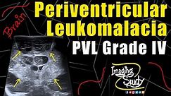 Periventricular Leukomalacia Grade IV || Ultrasound || Case 146