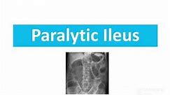 What is Paralytic Ileus & Causes | Methods for diagnosing Paralytic Ileus | Pathology Lecture