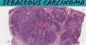 Sebaceous carcinoma: 5-Minute Pathology Pearls