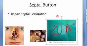 ENT Septal Button Septum Perforation Causes Nose Nasal Treatment Silastic