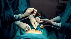 La liposucción pasó a ser la cirugía estética más común en todo el mundo, este es el top 5