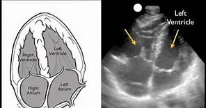 How to: Cardiac Ultrasound - Apical View Case Study