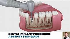 Dental Implant Procedure: A Step by Step Guide