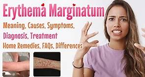 Erythema marginatum overview, meaning, signs and symptoms, diagnosis, treatment, home remedies, FAQs