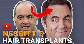 James Nesbitt's Hair Transplant - The Complete Story