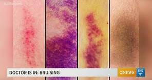 Why bruising matters and what the purple, blue, and yellow marks can indicate