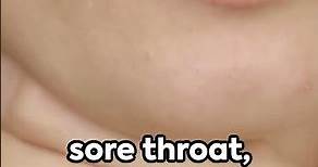 Strep Throat: Causes, Symptoms, and Diagnosis