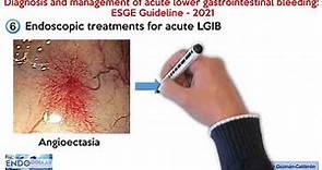 Diagnosis and management of acute lower gastrointestinal bleeding: ESGE Guideline - 2021