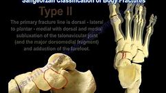 Navicular Fractures - Everything You Need To Know - Dr. Nabil Ebraheim