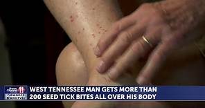 West Tennessee man gets more than 200 seed tick bites all over his body