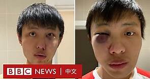 新冠肺炎：亞裔留學生受歧視 倫敦街頭被毆打－ BBC News 中文