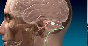 Deep Brain Stimulation for Stroke Recovery Animation