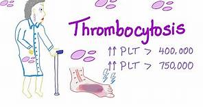 Thrombocytosis (primary and secondary) | Why Is My Platelet Count High?