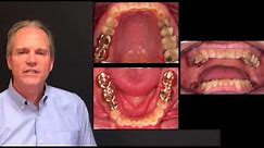 Vertical Dimension of Occlusion - Dr. Brian Mills