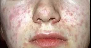Measles. Koplik spots, blanching rash Morbillivirus