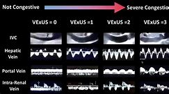 🔴 Fluid Overload and Venous Congestion Assessment - Venous Excess Ultrasound (VExUS) Step 1: IVC Diameter: If >2cm, proceed to step 2 Step 2: Hepatic Vein Doppler Step 3: Portal Vein Doppler Step 4: Renal Vein Doppler 💥 Interpretation: 👉Grade 0 (no congestion): IVC 2cm and any combo of Normal or Mildly Abnl Patterns 👉Grade 2 (Moderate congestion): IVC >2cm and ONE Severely Abnl Pattern 👉Grade 3 (Severe congestion): IVC >2cm and > 2 Severely Abnl Patterns #VenousExcess #Ultrasound #VExUS #di