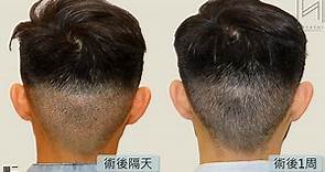 寇約翰植髮-秀冠植髮診所 成功率超過90%_院長林俊志醫師全程親自操刀