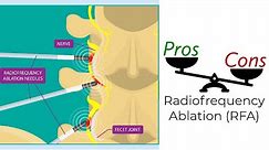 Radiofrequency Ablation - Pros & Cons