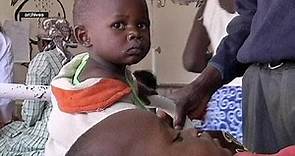 Riesgo de epidemia de Meningitis C en Africa