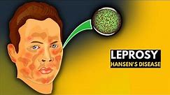 Leprosy (Hansen's disease): Everything You Need to Know