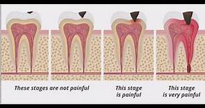 Stages of Tooth Decay: Introduction