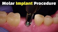 Step by Step Dental Implant Procedure - Back Molar