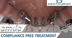 amda® - compliance-free treatment (advanced molar distalization appliance)