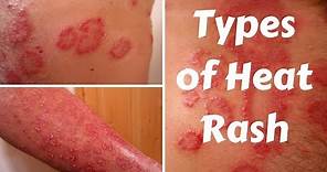 Types of Heat Rash