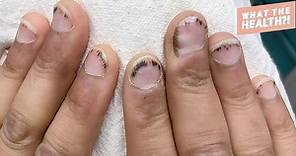 What Are Splinter Hemorrhages of the Nails?