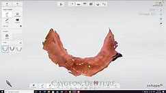Scanning Workflow to Fabricate a Complete Lower Denture