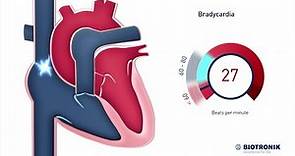 Che cos'è una frequenza cardiaca lenta? | Animazione medica